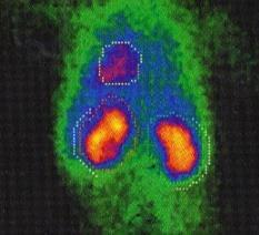 Risk för njurskada Obstruktion Vesikoureteral reflux Recidiv Inflammation högt