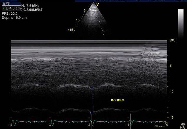 Torakala aorta