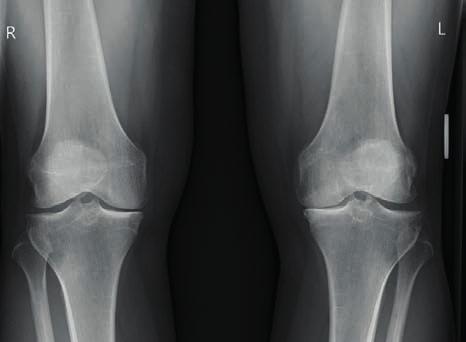 Förberedelser inför operationen Långt framskriden ledförslitning i vänster knä. Ledspringan på knäts inre sida har blivit lägre och lindrig hjulbenthet (varusställning) har utvecklats i knät.