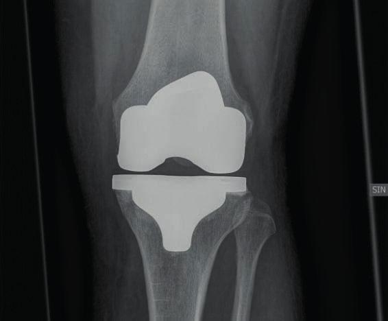 En knäprotesoperation utförs när en ändamålsenligt genomförd konservativ behandling inte har gett tillräcklig lindring av symtomen och det syns en klar förändring på röntgenbilden.