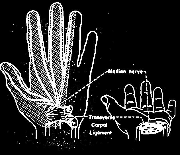 skogsarbetare, betongarbetare, elektriker) ~1% karpaltunnelsyndrom (betongarbetare, plåtslagare, svetsare) Akut - övergående Handens anatomi Akuta effekter av exponering för