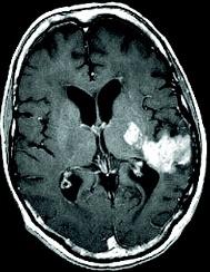 A B C Figur 3. Hjärntumör. Kontrastförstärkt T1-viktad (A), FLAIR (fluid-attenuated inversion recovery) (B) och T2-viktad MRI (C) av ett glioblastoma multiforme.