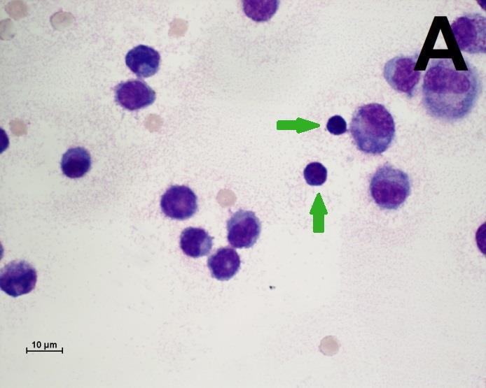 Figur 2. Giemsafärgade cytospinpreparat på ledvätska (1000x med olja). (A) Lymfocyter (gröna pilar) och stora mononukleära celler ses på bilden.