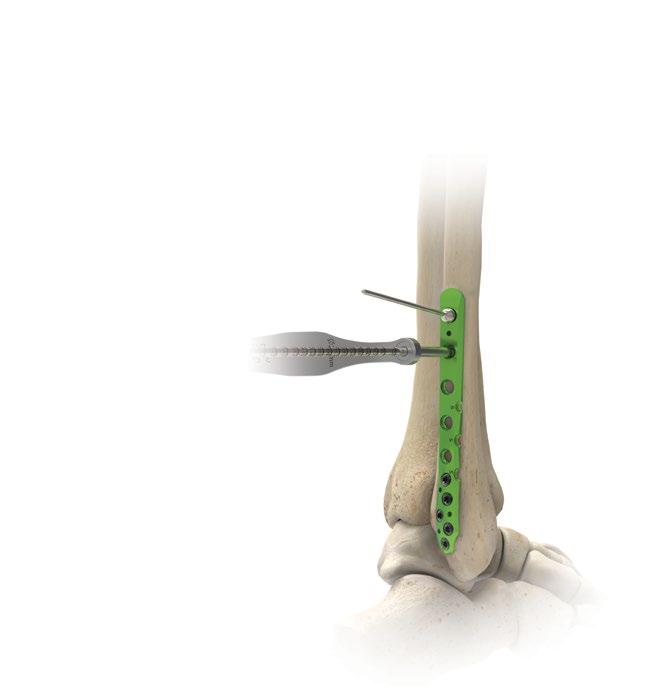 Posterolateral fibulaplatta operationsteknik [forts.] Figur 17 5 Proximal placering av 3,5 mm sexkantsskruv 3,5 mm sexkantsskruvar passar i alla proximala platthål.