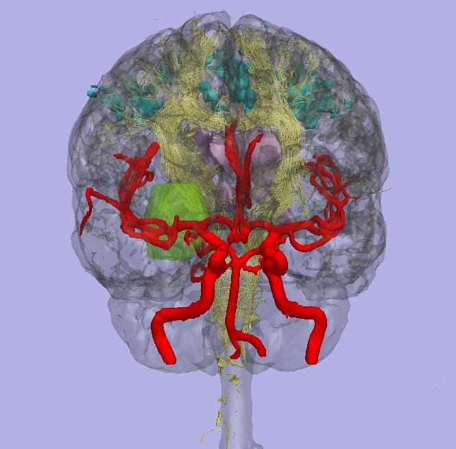 Diffusions MR bild This image displays the cortical surface in transparent gray.