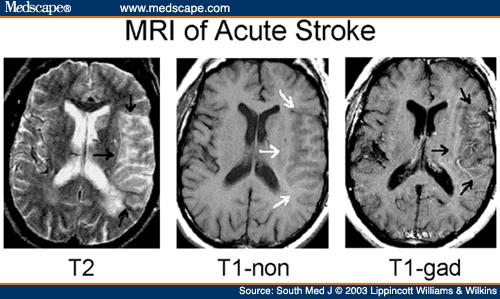 MR-bilder av stroke MRI of acute middle carotid artery (MCA) stroke on MRI at 12 hours postictus. T2-weighted image shows mild hyperintensity of the middle carotid artery territory (arrows).
