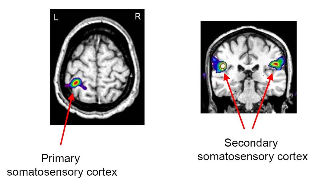 Funktionell MRI Lokalisering av motoriska centra genom fmri där dessa