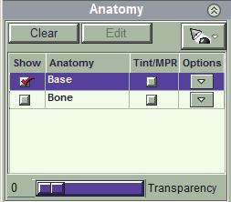 Vitrea lägger till en listpost i anatomihanteringsområdet. Standardinställningen för visning av Bone (ben) är inte vald, så den visas inte. OBS!