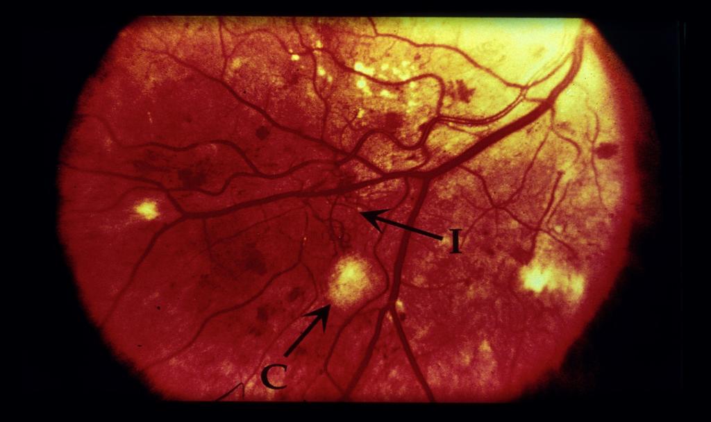 Retinopati C=bomullsexudat (kärlläckage) I=IRMA (ischemisk mikroangiopati med kärlnybildning) Nefropati - epidemiologi