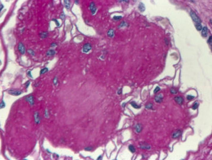på tidig kärlskada i njuren - ökad risk för utveckling av njursvikt Riskmarkör för aktuell/framtida hjärt-kärlsjuklighet och