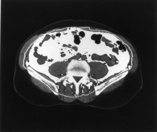 Metabol syndrom Störd glukosmetabolism, IGT, typ 2 diabetes Bukfetma Hypertoni Lipidstörning - höga TG, små LDL, FFA - lågt HDL-kolesterol Hemostas-störning - höga PAI-1, fibrinogen, vwf, EVF