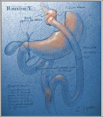 -Insulin Tarmen -Alfa-glukosidas hämm are -GLP1 analoger -Gallsyra-bindar e* Överviktskirurgi Behandlingsmål vid diabetes