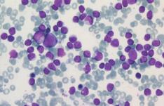 Diagnostisk/terapeutisk betydelse Prognostiska markörer (riskgruppering) Förbättra klassifikationer Följa klonal utveckling Följa