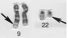 Inhibition of BCR-ABL as therapy for terapi CML KML ett paradigm för genetiskt målriktad Kvantitativ RT-PCR för