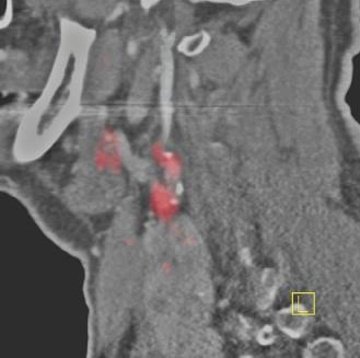 procents årlig ipsilateral strokefrekvens, i jämförelse med 2,2 procent i ACAS-studien 1995 [22].