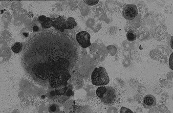 mg/kg. Partiell hematologisk rekonstitution uppnåddes, men efterförloppet komplicerades av en JK-virusassocierad hemorragisk cystit.