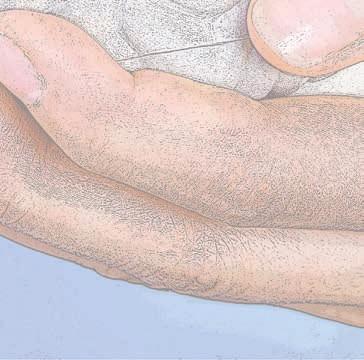 Svårigheten att ställa diagnosen Lewy body-demens visar sig i att en initialt felaktig