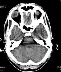 Stroke i bakre cirkulationen 1/5 av alla stroke Sämre kunskapsläge jämfört med stroke i främre cirkulationen Diagnostiska