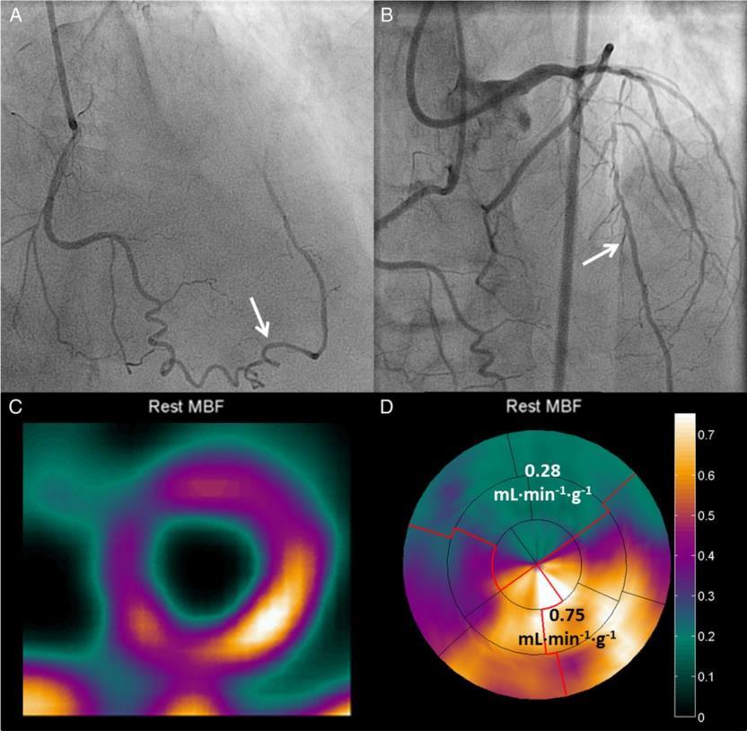 CTO området är ischemiskt trots välutvecklade kollateraler PET för myocardial blood flow (MBF) och Coronary Flow Reserve (CFR) MBF kvot (target/remote) <0,75 in 96% CFR < 2,0 in