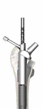 Beroende på om/vilken proximal provspacer används skruvas en kort provskruv (då ingen proximal spacer eller en 10 mm proximal provspacer används) eller en lång provskruv (för 20 mm proximal