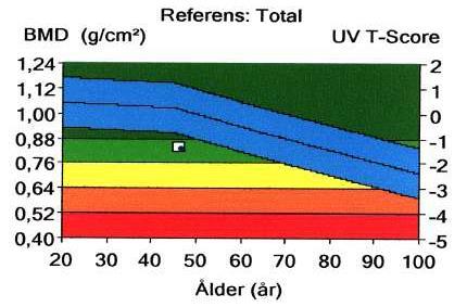 WHO-kriterier för osteoporos Normal bentäthet när T-scorevärdet är högre än 1SD Osteopeni vid T-score -1 till 2,5 SD