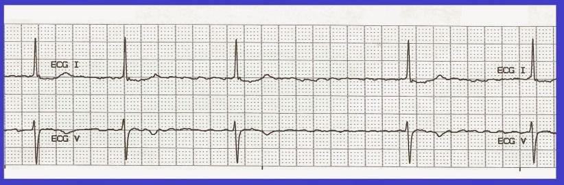 På sjukhuset Blek, trött EKG; FF, Frekvens 35,