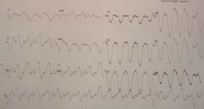EKG-bild: