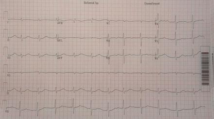 Amitriptylinintoxikation QRS-bredden minskar.