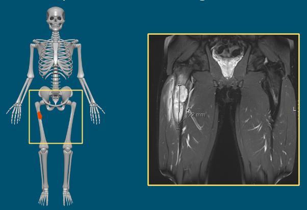 Figur 2. Bilden illustrerar Ewings sarkom i höger femur. Publicerad med tillstånd från Referens [2]. Figur 3. Före strålbehandling opereras ett skelettsegment ut från höger femur.