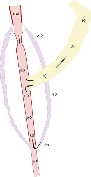 Steal Figure 2. An upstream arterial stenosis leads to mean arterial pressures (MAP) that are lower (e.g. 60%) compared to values observed in its distal portions (80%) due to open collaterals.