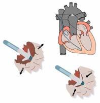 Cardiac Contractility Tidig detektion av lungödem Relaxed + - RV Contractility Mäter DC impedansen över lungan Contracted Rate increase: High contractility High heart rate CASE i u Impedance