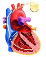 Pacemakerelektroden Pacemaker- och defibrilleringselektroder Överför elektrisk energi från pulsgeneratorn till myokardiet, stimulation, impedansmätning.