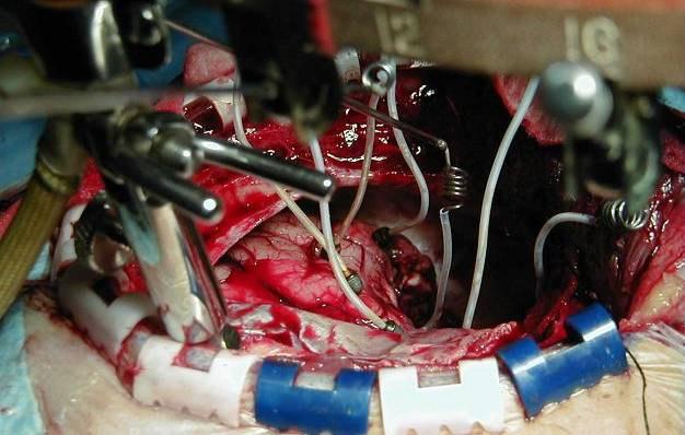 REGISTER OCH UTVÄRDERING AV RESULTATEN EFTER KIRURGISK EPILEPSIBEHANDLING RAPPORT ÖVER VERKSAMHETEN ÅR 2002 Bilden visar ett elektrokortikografi instrument applicerat för registrering av EEG signaler