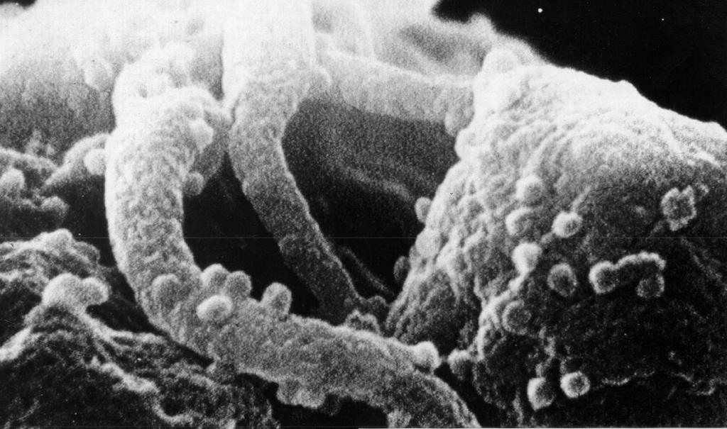 HIV producerande lymfocyt,