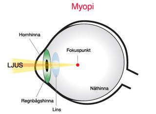 1. Ljuset åker igenom den konvexa linsen som samlar ihop ljusstrålarna. Muskler runt linsen kan få den att ändra form så man ser skarpt på både långt och kort håll. 2.