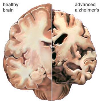 Cortex skrumpnar och ger mindre utrymme för nervcentra för tankeförmåga, planering och