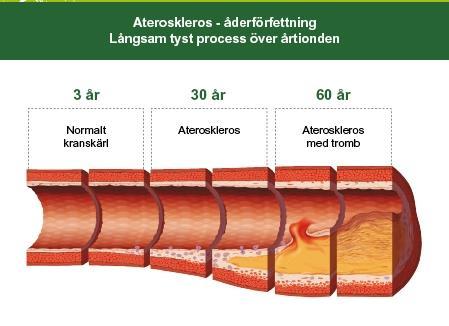 Aterosklerosens