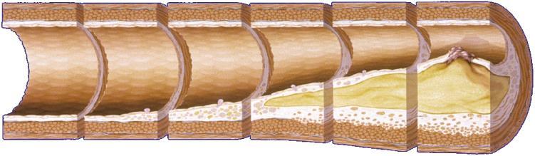 Tidslinje ateroskleros Skumcell Fatty streak Intermediär lesion Aterom Fibröst plaque Komplicerad lesion/ruptur Det första årtiondet Endoteldysfunktion Från det tredje årtiondet