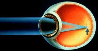 Närsynthet = Myopi Ögat är för långt. Bilden faller framför näthinnan.