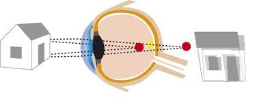 Brytningsfel = astigmatism Den största anledningen till astigmastism är att hornhinnan inte bryter bilden