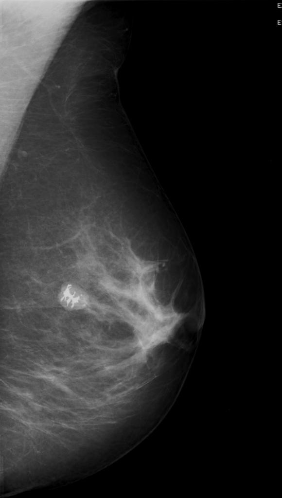 14 nödvändigt. Kvinnor med en genetisk predisposition för bröstcancer hålls under strängare uppsyn och en invasiv behandling kan bli aktuell.