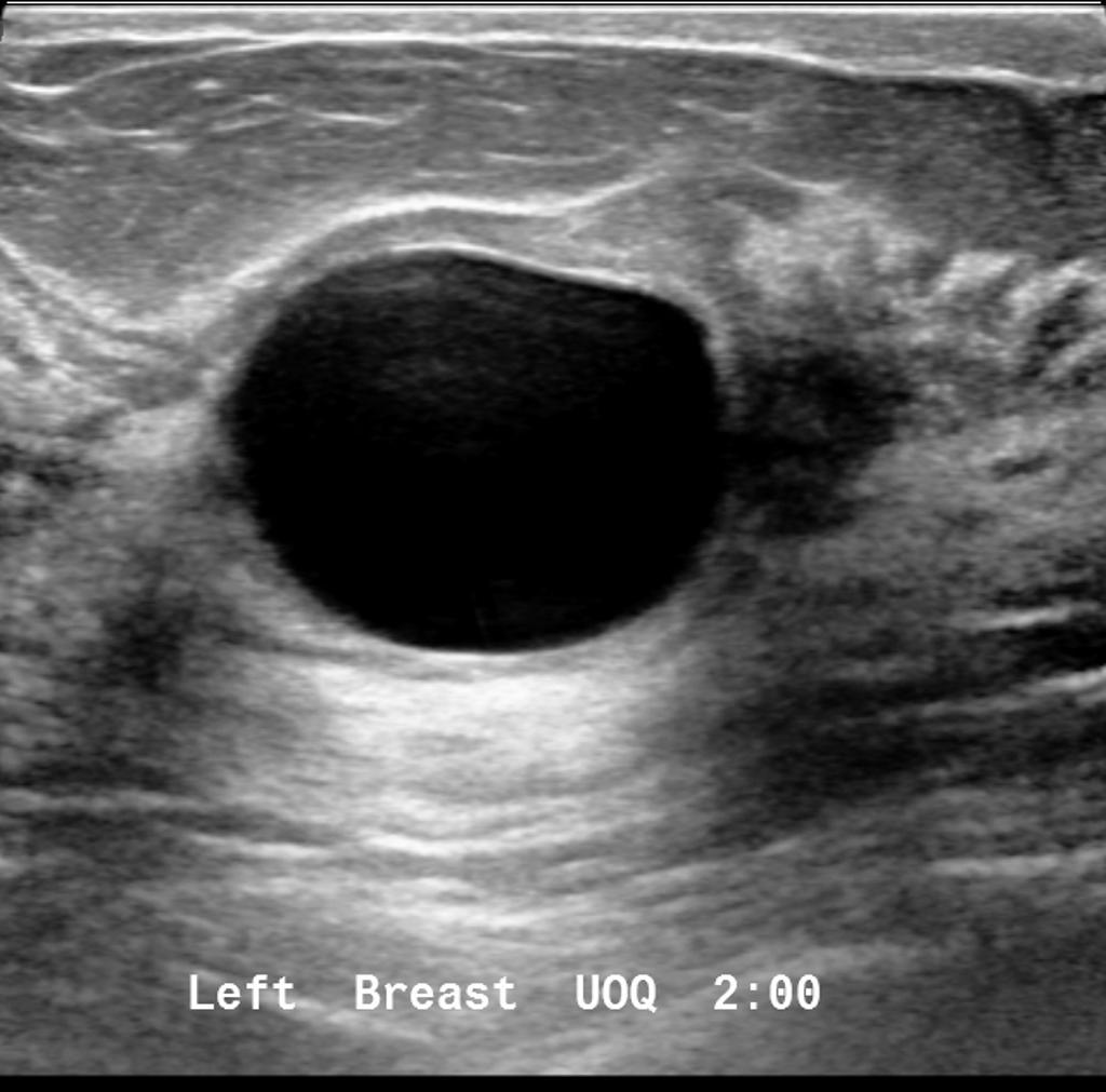 Figur 3. Cysta i bröst, avbildad med ultraljud 16 Bild från www.radiopedia.org 4.2.4 Mastit Mastit, eller mjölkstockning som det även kallas, är en inflammatorisk reaktion som uppstår i bröstkörteln.