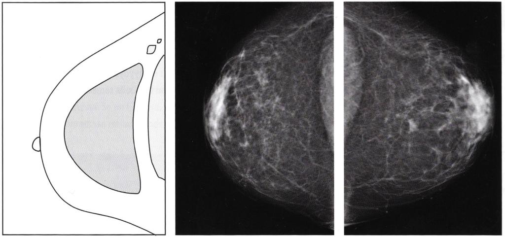 Bildkriterier för Craniocaudal projektion: 25 - Bröstet placerat mitt på bildplattan. - Bröstmuskeln ska synas som en båge i bakre (dorsala) delen av bilden.