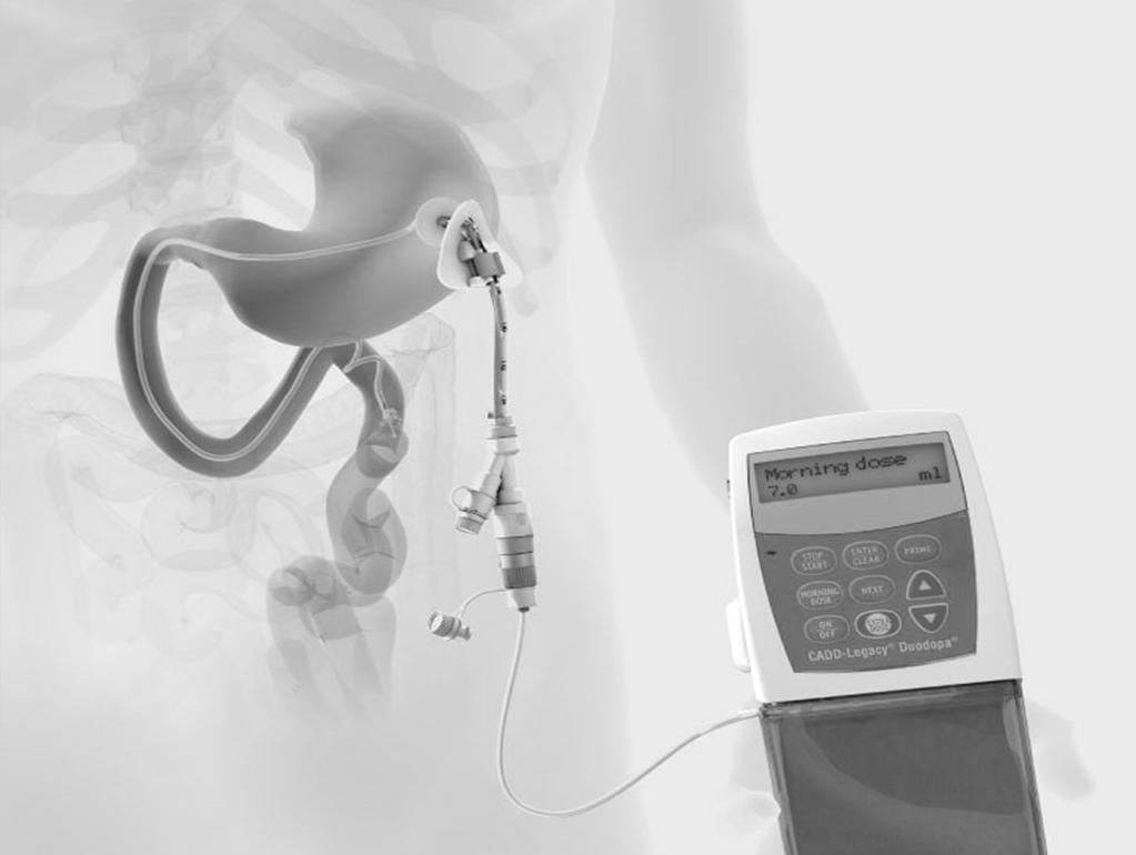 LEVODOPA/KARBIDOPA INTESTINALGEL INFUSION (LCIG) Kontinuerlig infusion av Levodopa/Karbidopa-gel till tunntarmen via en PEG Indikation: Parkinsons sjukdom i komplikationsfas med