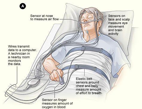 Diagnos Diagnos ställs med hjälp av Anamnesen Polysomnografi Sleep latency test Förberedelser