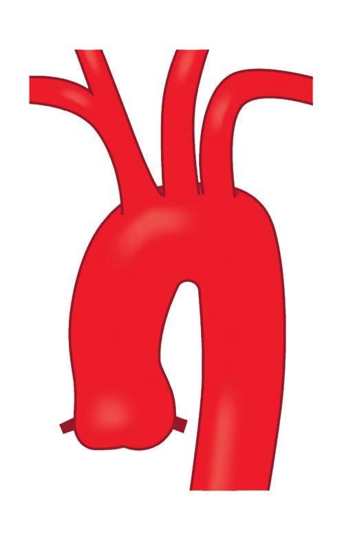 AORTASJUKD OMA R 9 Höger karotisartär (försörjer huvudet med syrerikt blod) Vänster karotisartär (försörjer hals och huvud med syrerikt blod) Höger subclaviaartär (försörjer höger arm med syrerikt