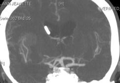 En viss omfördelning kan ske av likvor spinalt, men den vägen blir ju stängd i just dessa fall Neurologiveckan 11 maj 2017 Rydenhag 7 Neurologiveckan 11 maj 2017 Rydenhag 8