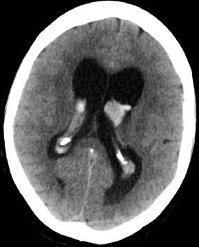 Dessa patienter vårdas ju bäst på en dedicerad neurointensivvårdsavdelning i