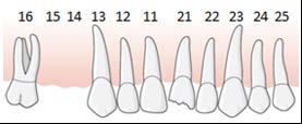 109 De fyra underkäksincisiverna är gravt slitna och mer än en tredjedel av tandkronans höjd är förlorad.