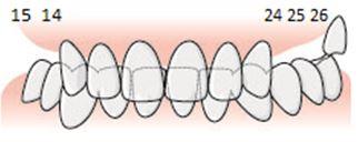 110 6.5.3.2.5 Exempel, betthöjning på grund av utrymmesbrist En patient har inga tänder bakom 13 på höger sida i överkäken samt en tretandslucka 24 26 på vänster sida.
